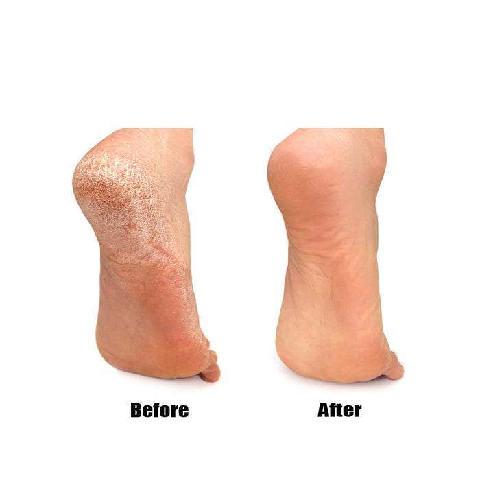 Foot Callus Remover Shaver Disposable Pedicure Foot Care Hard Skin Dry Callus